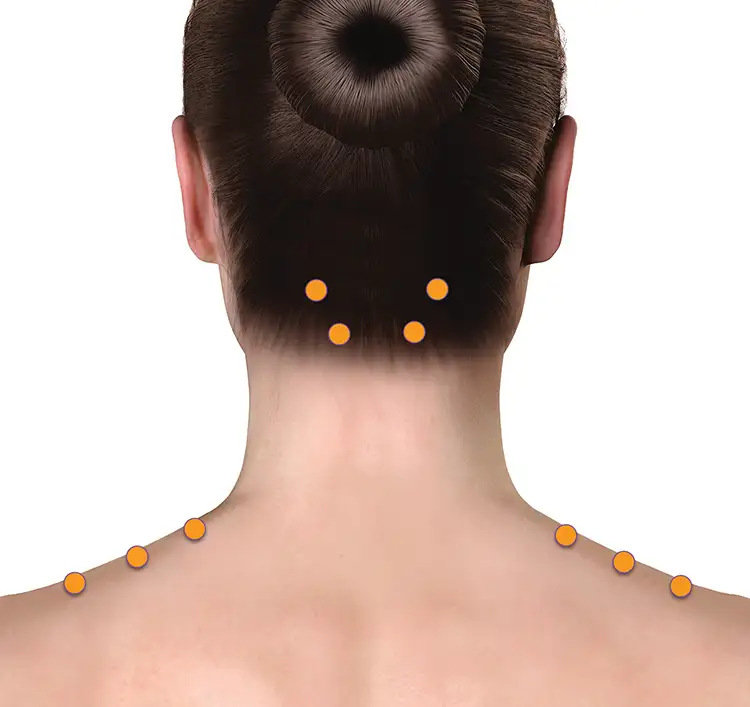 Botulinum toxin injection sites for cervical dystonia. Four are at the base of the neck and 3 on the trapezius on each side